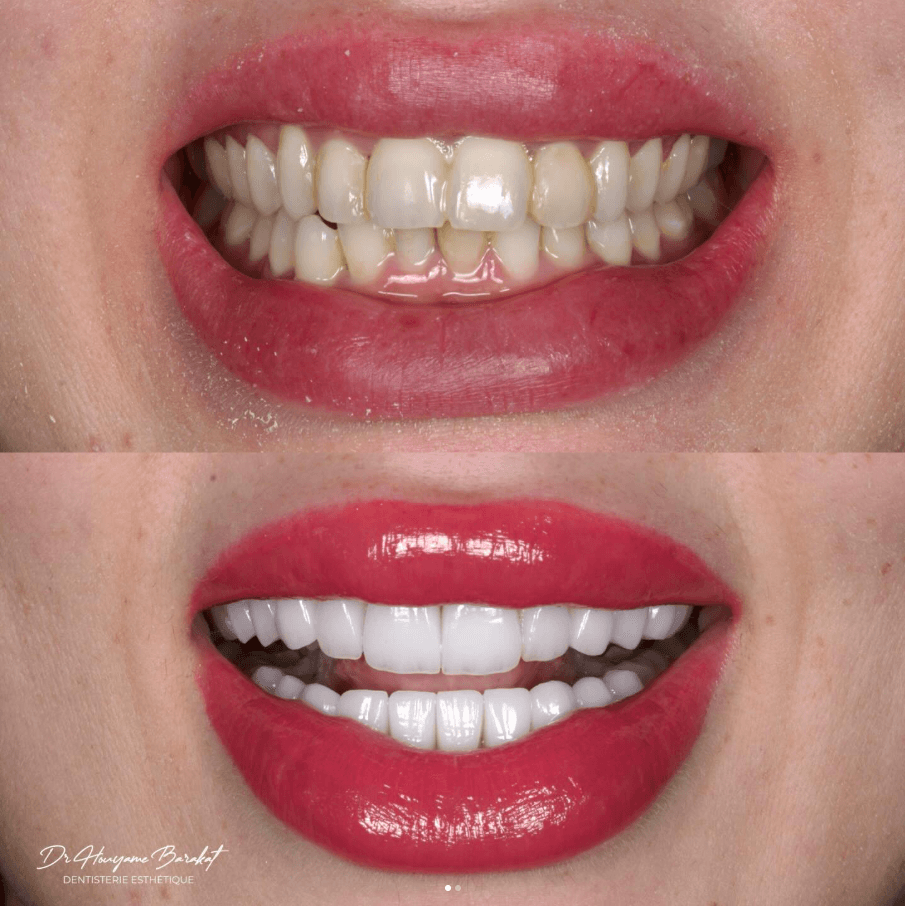 Sourire naturel et lumineux — résultat clinique